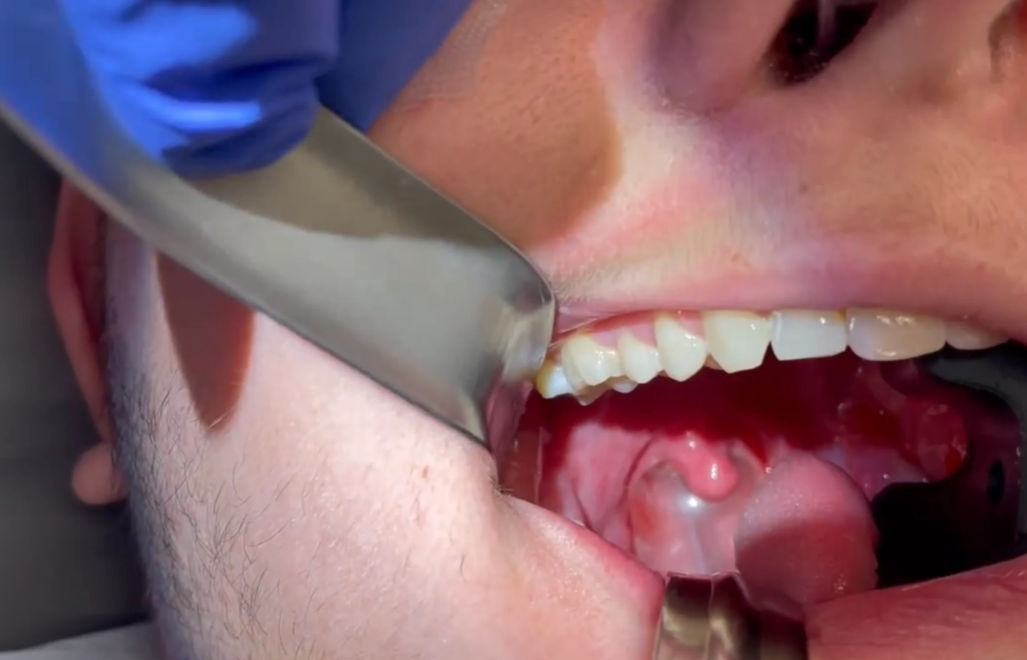AMtubation Nasal Airway Device in Use